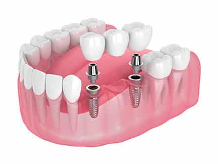 multi tooth dental implant