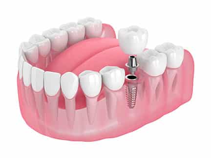 Single Tooth Implants