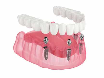 Full arch dental implant